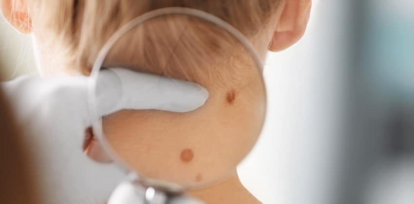 image of dermatologist expecting moles on the back of someone's neck