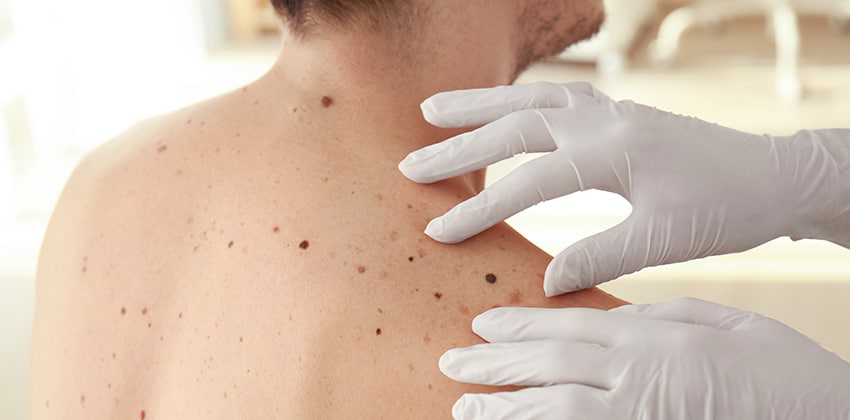 image of a dermatologist examining the moles on a patient's shoulder