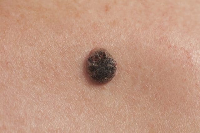 Udelade Peep Ristede How to tell if a mole is cancerous - Harris Dermatology
