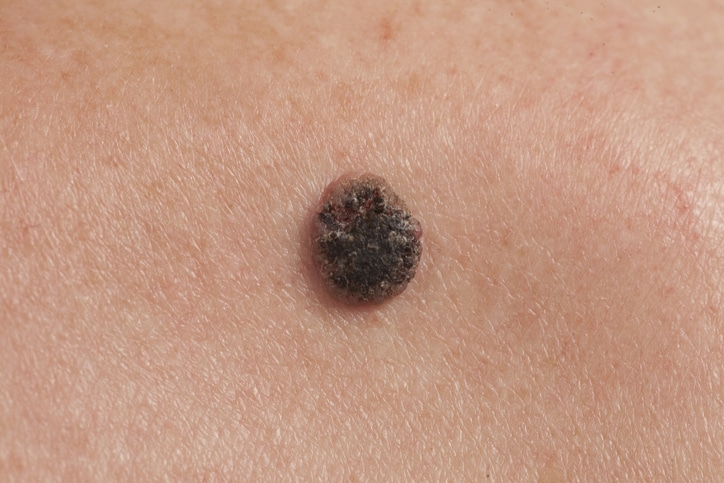 How To Tell If A Mole Is Cancerous Harris Dermatology