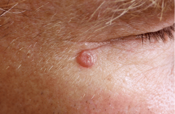 Is Basal Cell Carcinoma Serious Harris Dermatology