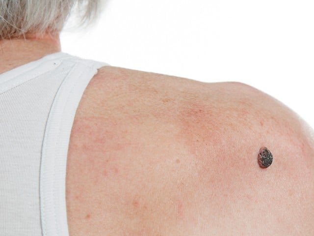 squamous cell carcinoma of the skin on the back of an elderly person