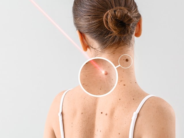 woman undergoing procedure of nevus removal by laser on light