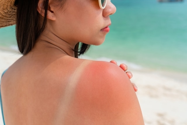 Red skin sun burn after Sunbathing at the beach